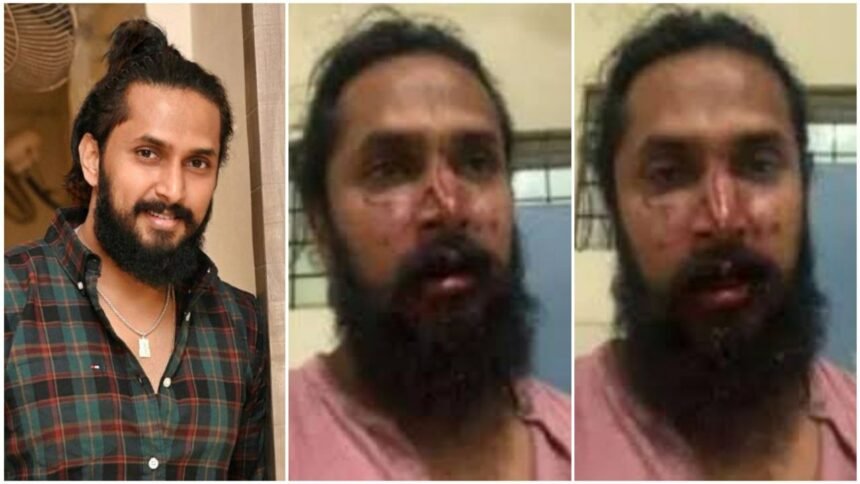 Mob attack on actor Chetan Chandra, the actor's nose was broken, he was returning from a temple visit with his mother, this is the reason for the attack