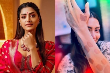 My body is 60% white. Vitiligo has no cure.  This is not a disease either