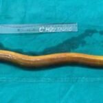 What was taken out was an eel 25 inches long and four inches wide. The live fish was inserted through the anus;  Limbs were bitten off
