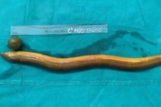 What was taken out was an eel 25 inches long and four inches wide. The live fish was inserted through the anus;  Limbs were bitten off