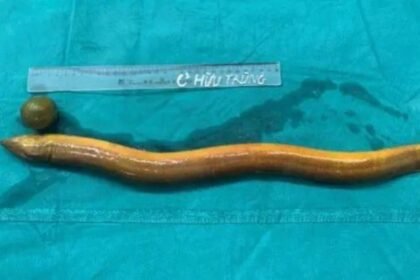 What was taken out was an eel 25 inches long and four inches wide. The live fish was inserted through the anus;  Limbs were bitten off